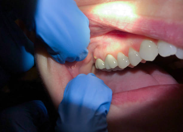 Best Dentist for Tooth Abscess  in Frankfort, MI